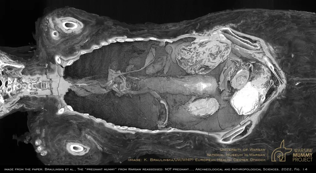 Trójwymiarowa monochromatyczna rekonstrukcja przekroju przez mumię wykonana za pomocą oprogramowania OsiriX MD (Pixmeo). Widok od przodu do wnętrza mumii wypełnionej pakunkami o różnym charakterze, z których część zawiera usunięte wcześniej i po osobnym zmumifikowaniu, włożone z powrotem narządy wewnętrzne. K. Braulińska (UW/WMP). Źródło: za artykułem w "Archeological and Anthropological Sciences" pt. The +pregnant+ mummy from Warsaw reassessed..."