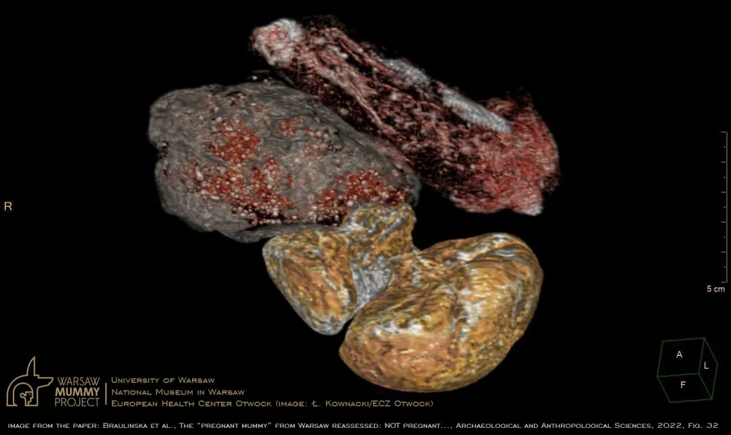 Trójwymiarowa rekonstrukcja oddzielnych pakunków obecnych w jamie miednicy mumii z prezentacją różnorodności materiałów. Trzy dolne pakunki łącznie, zostały wskazane przez poprzednich autorów jako obraz płodu. Jednak największy z nich, wypełniony ziarnistą i gęstą heterogenną substancją, z całą pewnością nie jest “główką płodu”. Ł. Kownacki (ECZ Otwock). źródło: za artykułem w "Archeological and Anthropological Sciences" pt. The +pregnant+ mummy from Warsaw reassessed..."