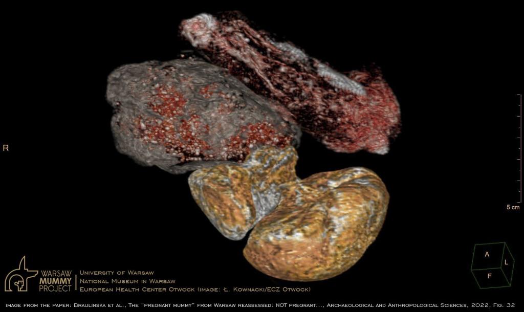 3D reconstruction of separate packages present in the pelvic cavity of the mummy  presenting diverse materials. The three lower packages considered as one were indicated by previous authors as a fetus. However, the largest of them, filled with a granular and dense heterogeneous substance, is certainly not the “head of a fetus”. Ł. Kownacki (ECZ Otwock)