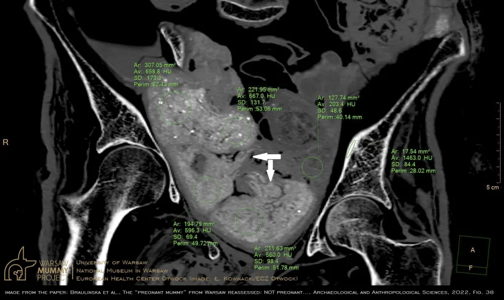 Przekrój przez miednicę mumii (widok od przodu) wykazuje różne gęstości wypełniających ją substancji. Pomimo braku szkieletu i struktur anatomicznych, układ pakunków oraz najpewniej luźne końce zawiniątek materiału, przedstawiały w oczach “odkrywców ciąży” (jak podali) iluzoryczne “rączki i nóżki płodu” (strzałki). Przekrój przez największy pakunek (“główkę”) ujawnia ziarnistości i wysoką gęstość zawartego w nim materiału. Ł. Kownacki (ECZ Otwock). Żródło: j.w.