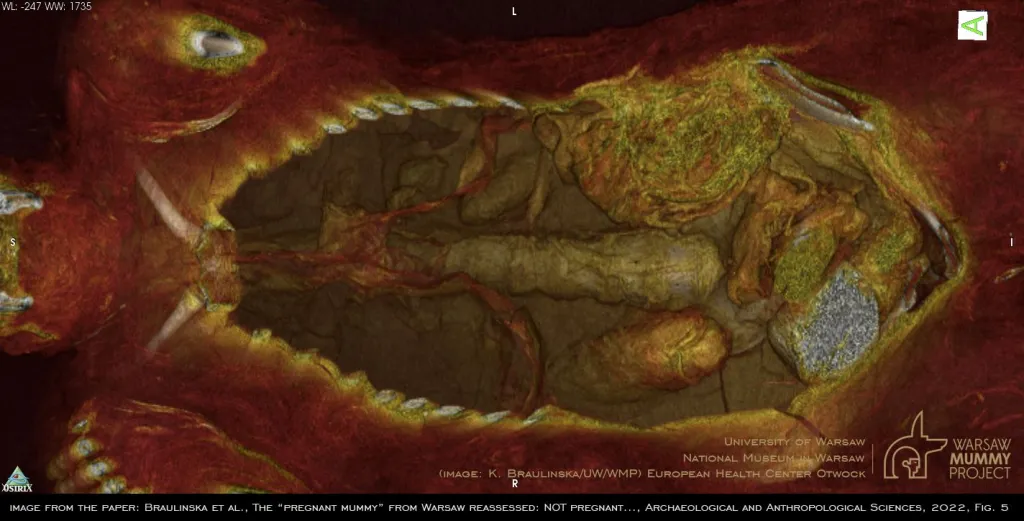 Trójwymiarowa kolorowa rekonstrukcja przekroju przez mumię, wykonana za pomocą oprogramowania OsiriX MD (Pixmeo). Widok od przodu do wnętrza mumii wypełnionej pakunkami o różnym charakterze, pakunki są częściowo zanurzone i utrwalone w wypełniającej jamy wnętrza mumii poziomie żywicy. K.Braulińska (UW/WMP). źródło: za art. w "Archeological and Anthropological Sciences": The +pregnant+ mummy from Warsaw reassessed..."