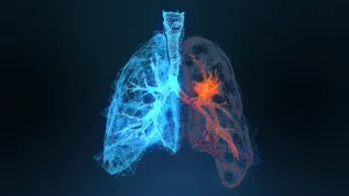Trójwymiarowy obraz raka płuca, Adobe Stock