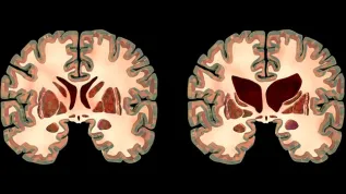 Przekrój mózgu osoby zdrowej i osoby z chorobą Huntingtona, Adobe Stock
