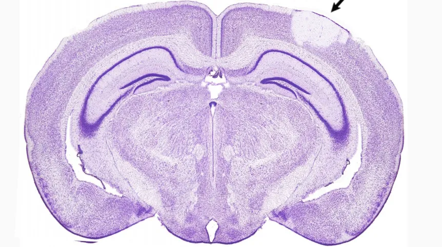 Udar niszczy strukturę tkanki nerwowej. Na preparacie mózgu szczura komórki są wybarwione na fioletowo. Strzałka wskazuje miejsce udaru, w którym komórki obumarły. Źródło: Instytut Nenckiego 